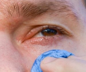 конъюнктивит боль и раздражение глаза глаукома покраснение глаза